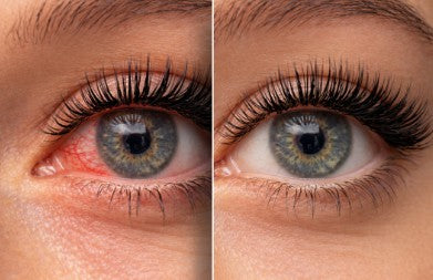 Műszempilla allergia tünetei és kezelése
